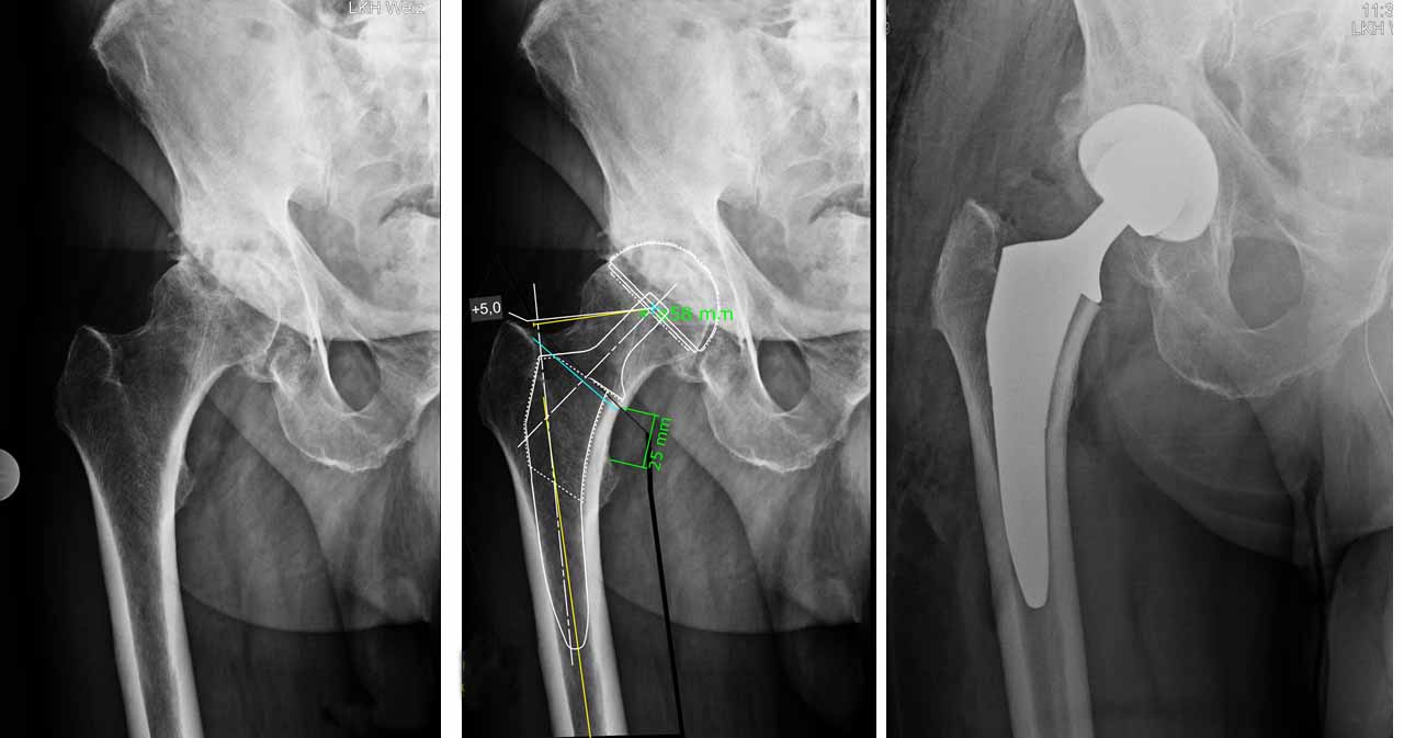 Dr Reinhard Hofer Stv. Leitung Hüftchirurgie LKH-Graz Facharzt für Orthopädie & Unfallchirurgie